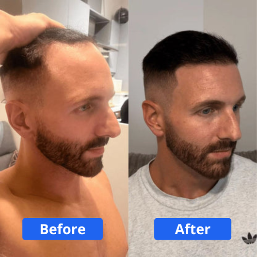 Him + - Hair Growth Serum