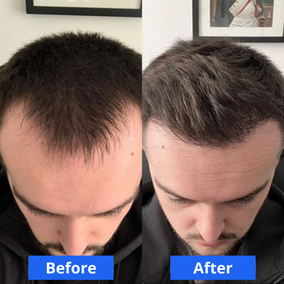 Him + - Hair Growth Serum